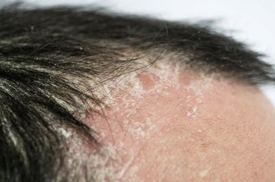 [GIẢI ĐÁP] cách chữa bệnh vẩy nến da đầu hiệu quả. Xem ngay! 